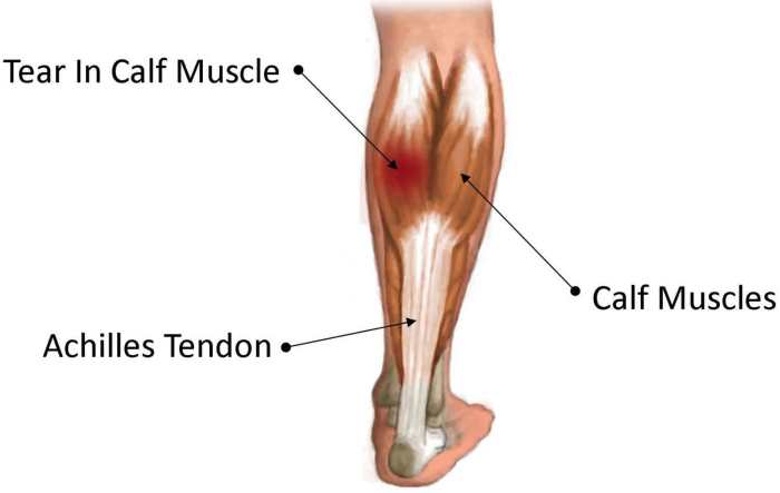 Which muscle is indicated by the arrow